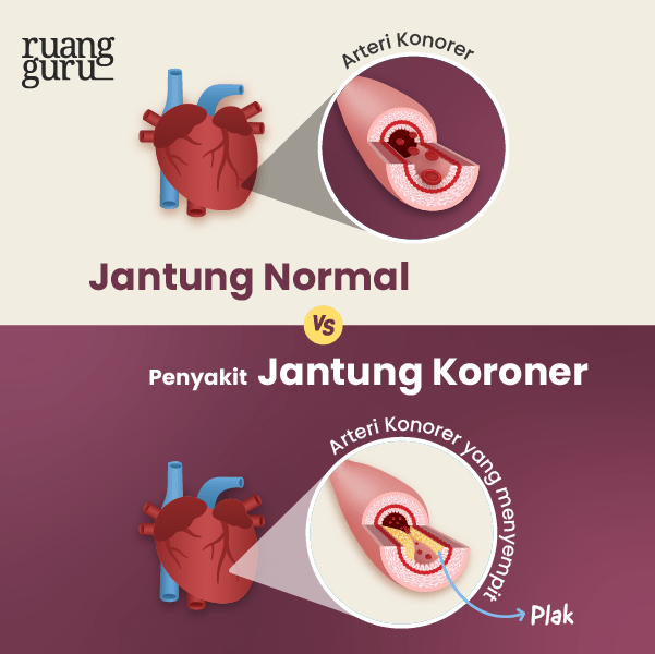 Fakta Seru - Bahaya Rebahan (Perbandingan Jantung Normal VS Jantung Koroner)