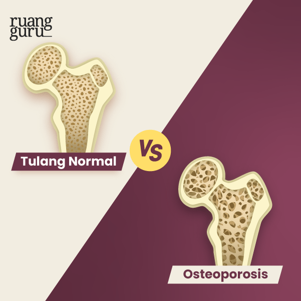 Fakta Seru - Bahaya Rebahan (Perbedaan Tulang Normal vs Osteoporosis)