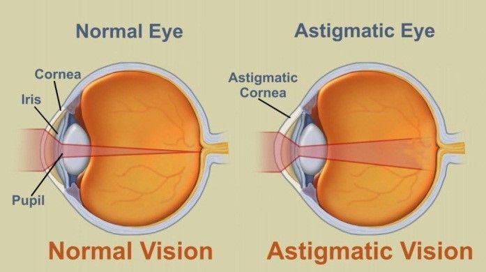 contoh astigmatisma